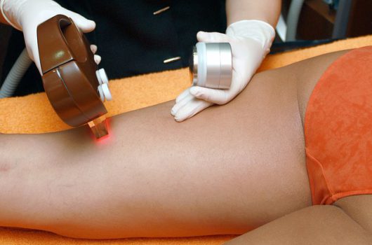 הסרת שיער לגברים בלייזר